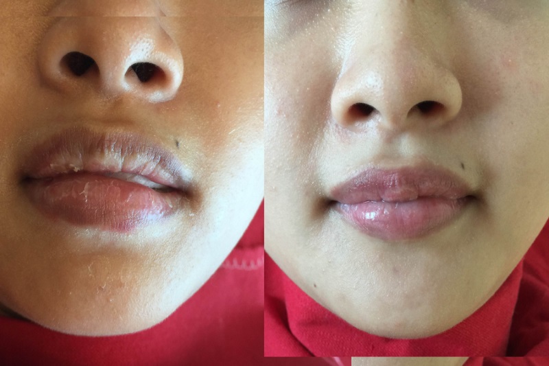 Chữa môi khô nứt nẻ